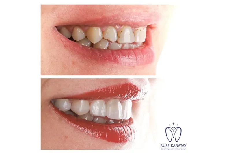 Gülüşünüzdeki Küçük Bir Dokunuş, Hayatınızdaki Büyük Değişim: Porselen Lamina İzmir